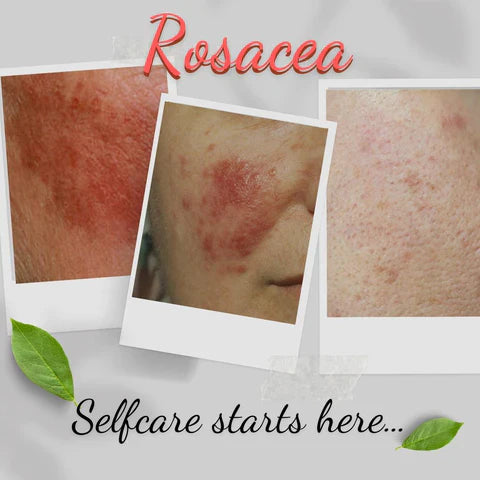 Facial Treatments For Rosacea Prone Skin